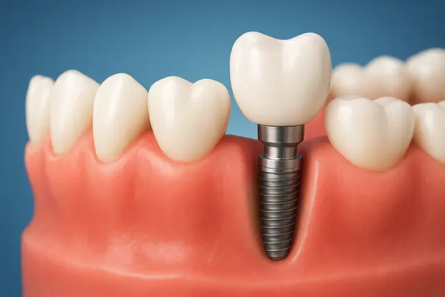 ایمپلنت اقساطی در اصفهان